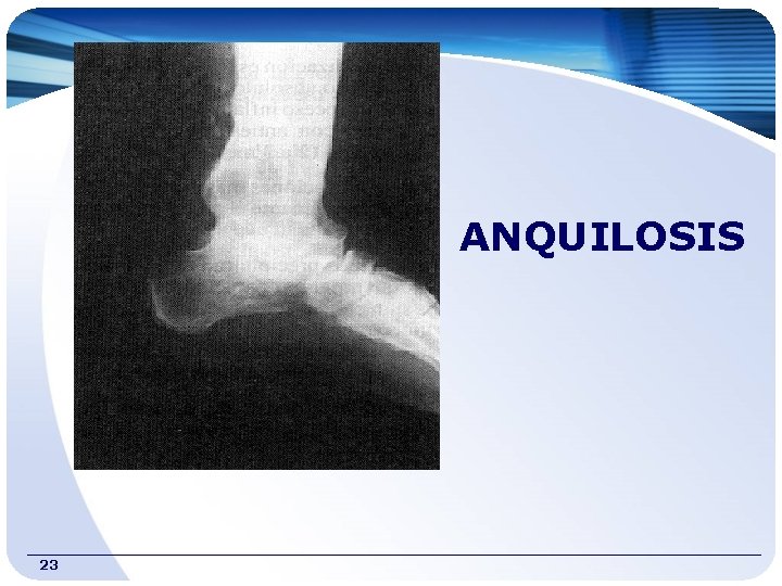 ANQUILOSIS 23 