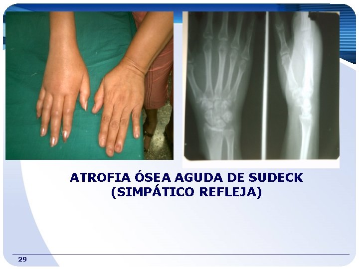 ATROFIA ÓSEA AGUDA DE SUDECK (SIMPÁTICO REFLEJA) 29 