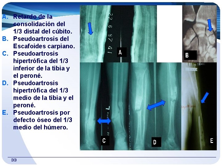 A. Retardo de la consolidación del 1/3 distal del cúbito. B. Pseudoartrosis del Escafoides