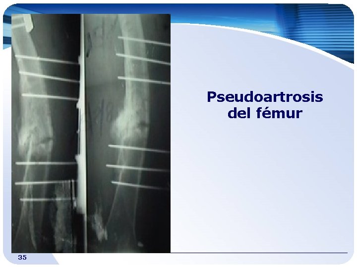 Pseudoartrosis del fémur 35 