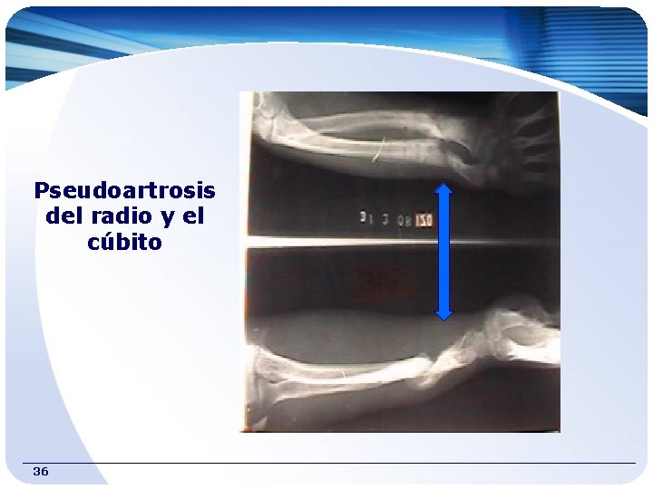 Pseudoartrosis del radio y el cúbito 36 