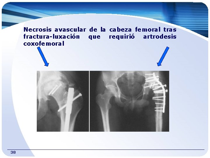 Necrosis avascular de la cabeza femoral tras fractura-luxación que requirió artrodesis coxofemoral 38 