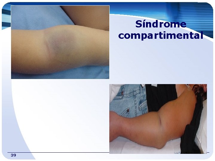 Síndrome compartimental 39 