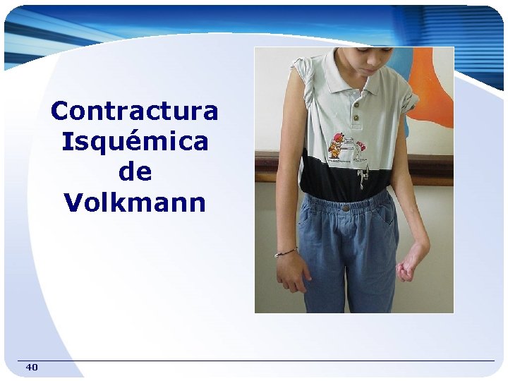 Contractura Isquémica de Volkmann 40 