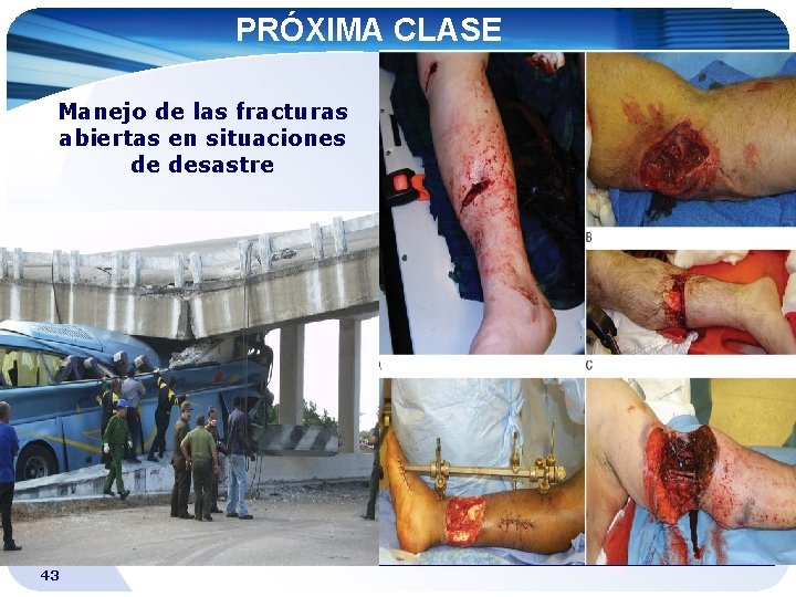 PRÓXIMA CLASE Manejo de las fracturas abiertas en situaciones de desastre 43 