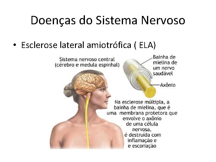 Doenças do Sistema Nervoso • Esclerose lateral amiotrófica ( ELA) 