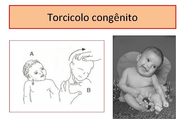 Torcicolo congênito 