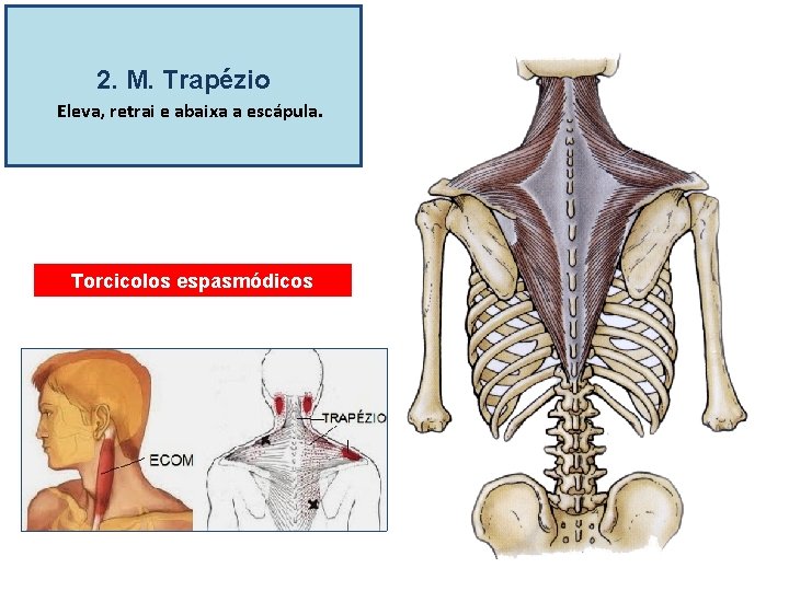 2. M. Trapézio Eleva, retrai e abaixa a escápula. Torcicolos espasmódicos 