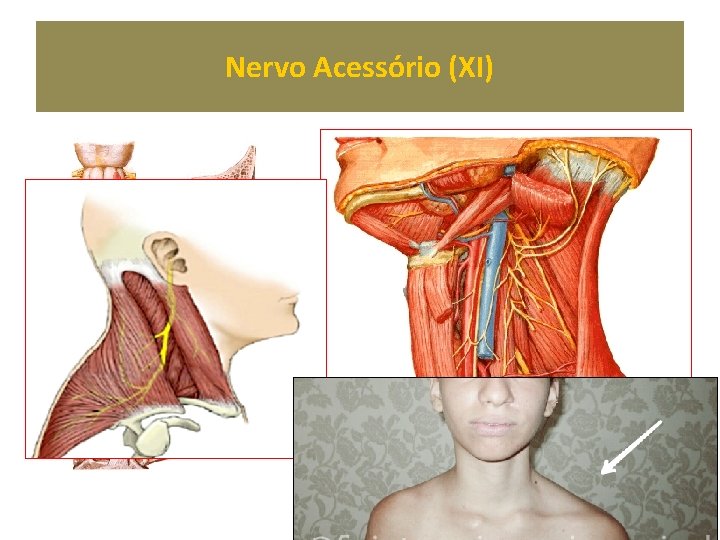 Nervo Acessório (XI) 