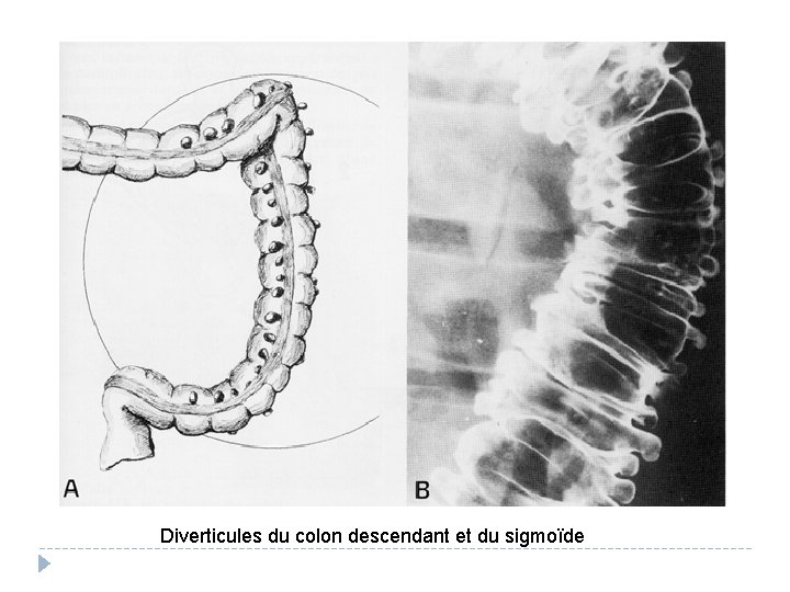 Diverticules du colon descendant et du sigmoïde 