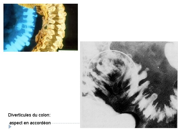 Diverticules du colon: aspect en accordéon 