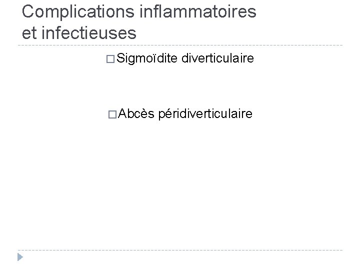 Complications inflammatoires et infectieuses � Sigmoïdite � Abcès diverticulaire péridiverticulaire 