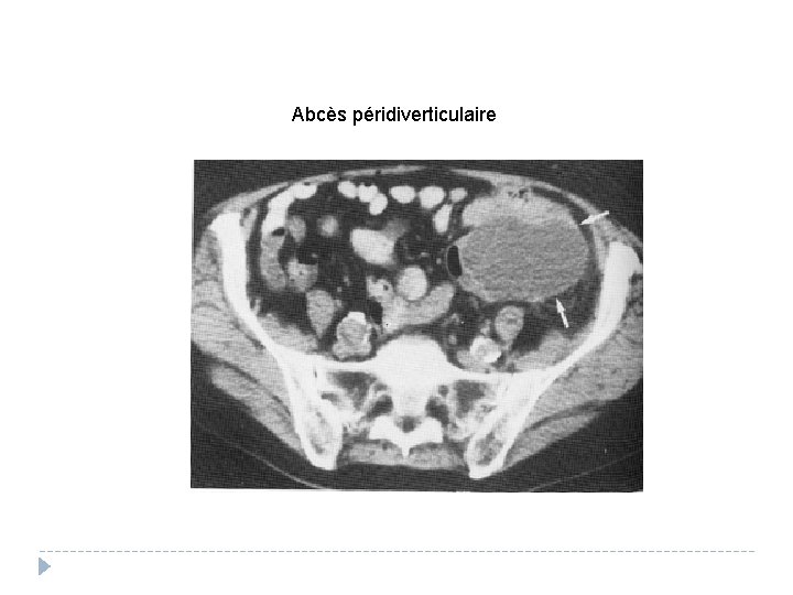 Abcès péridiverticulaire 