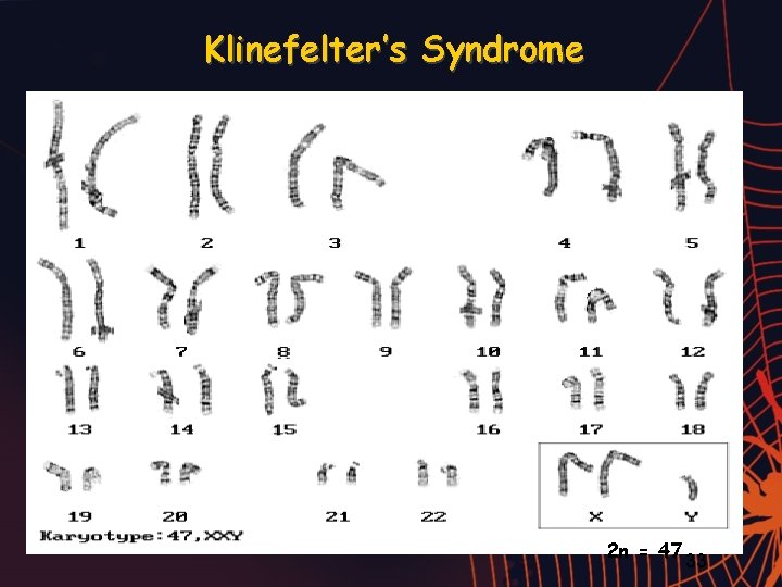 Klinefelter’s Syndrome 2 n = 47 33 