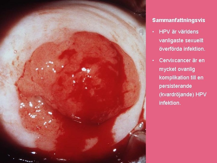 Sammanfattningsvis • HPV är världens vanligaste sexuellt överförda infektion. • Cervixcancer är en mycket Sammanfattningsvis • HPV är världens vanligaste sexuellt överförda infektion. • Cervixcancer är en mycket