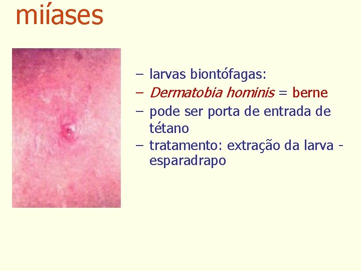 miíases – larvas biontófagas: – Dermatobia hominis = berne – pode ser porta de