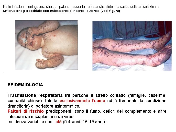 Nelle infezioni meningococciche compaiono frequentemente anche sintomi a carico delle articolazioni e un’eruzione petecchiale