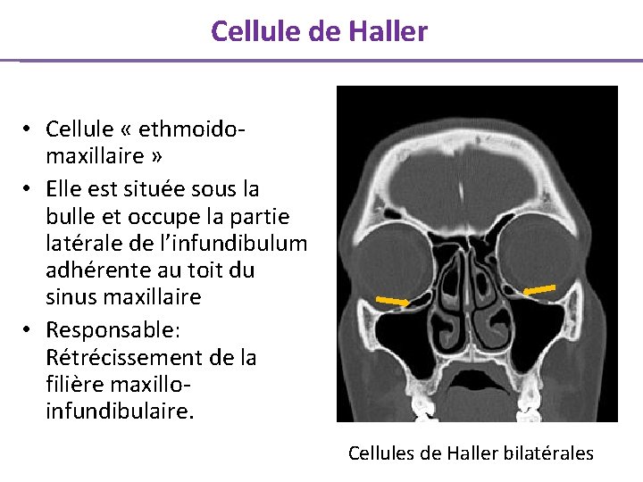 Cellule de Haller • Cellule « ethmoidomaxillaire » • Elle est située sous la