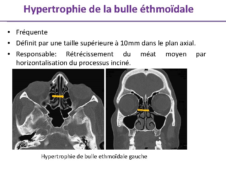 Hypertrophie de la bulle éthmoïdale • Fréquente • Définit par une taille supérieure à