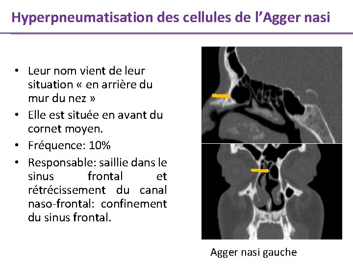 Hyperpneumatisation des cellules de l’Agger nasi • Leur nom vient de leur situation «