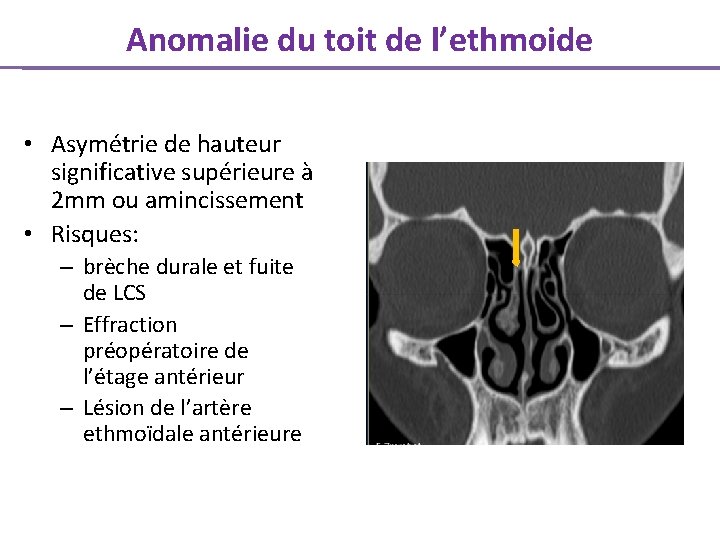 Anomalie du toit de l’ethmoide • Asymétrie de hauteur significative supérieure à 2 mm