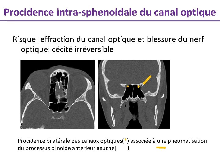 Procidence intra-sphenoidale du canal optique Risque: effraction du canal optique et blessure du nerf