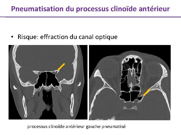 Pneumatisation du processus clinoïde antérieur • Risque: effraction du canal optique processus clinoïde antérieur