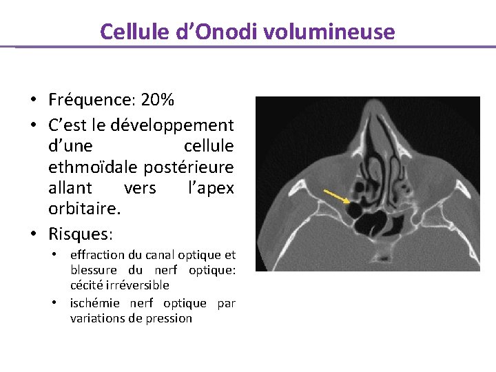 Cellule d’Onodi volumineuse • Fréquence: 20% • C’est le développement d’une cellule ethmoïdale postérieure