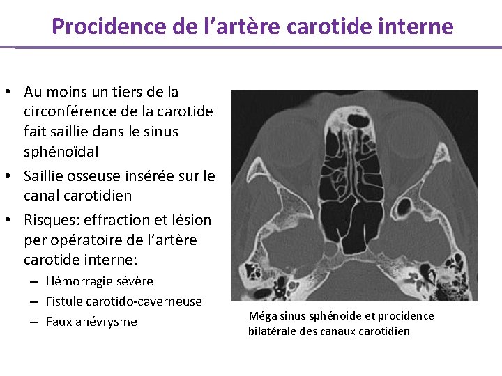 Procidence de l’artère carotide interne • Au moins un tiers de la circonférence de