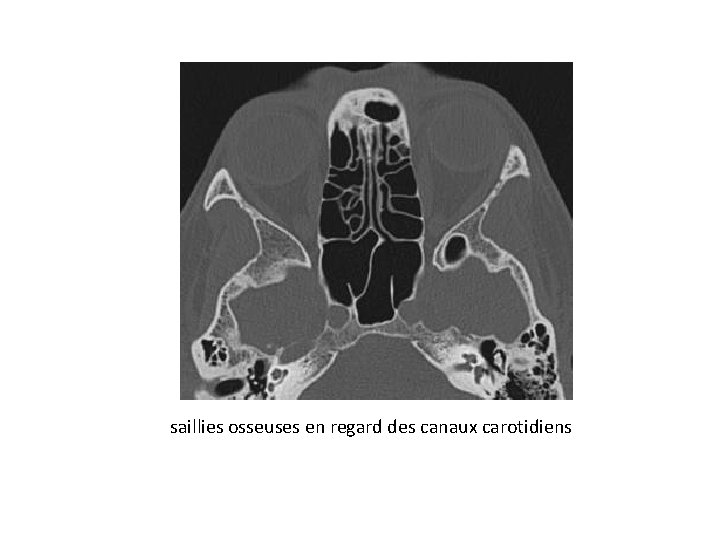 saillies osseuses en regard des canaux carotidiens 