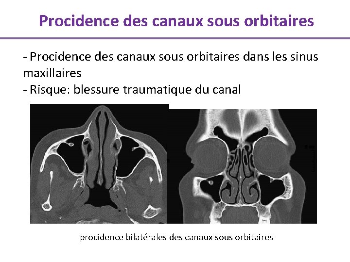 Procidence des canaux sous orbitaires - Procidence des canaux sous orbitaires dans les sinus