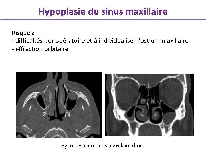 Hypoplasie du sinus maxillaire Risques: - difficultés per opératoire et à individualiser l’ostium maxillaire