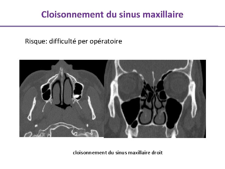 Cloisonnement du sinus maxillaire Risque: difficulté per opératoire cloisonnement du sinus maxillaire droit 