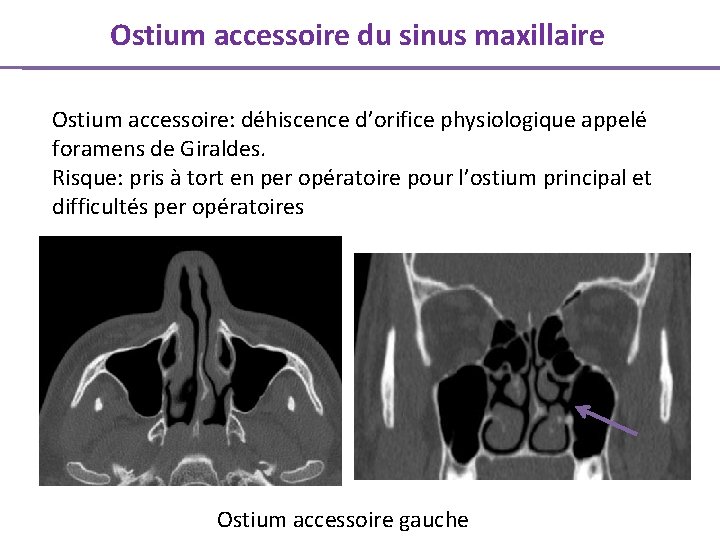 Ostium accessoire du sinus maxillaire Ostium accessoire: déhiscence d’orifice physiologique appelé foramens de Giraldes.