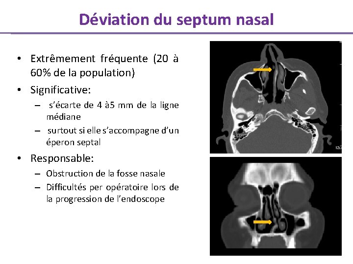 Déviation du septum nasal • Extrêmement fréquente (20 à 60% de la population) •