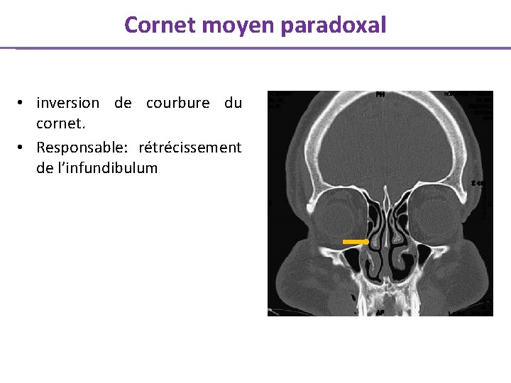 Cornet moyen paradoxal • inversion de courbure du cornet. • Responsable: rétrécissement de l’infundibulum