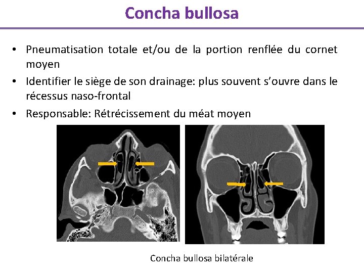 Concha bullosa • Pneumatisation totale et/ou de la portion renflée du cornet moyen •