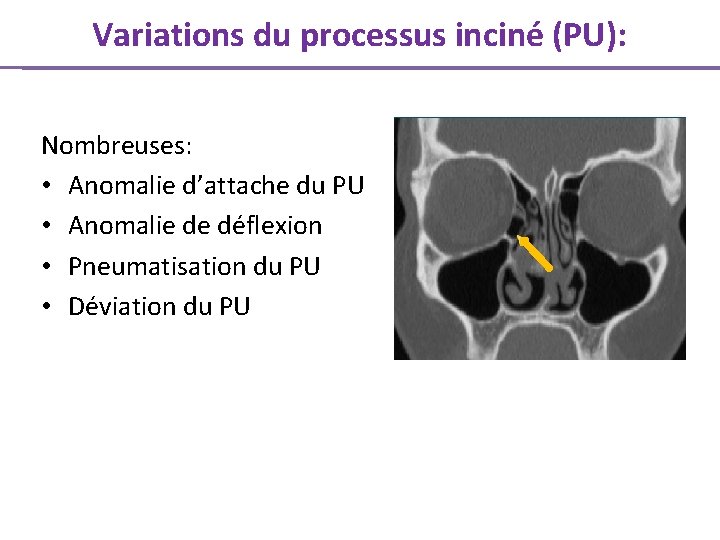 Variations du processus inciné (PU): Nombreuses: • Anomalie d’attache du PU • Anomalie de