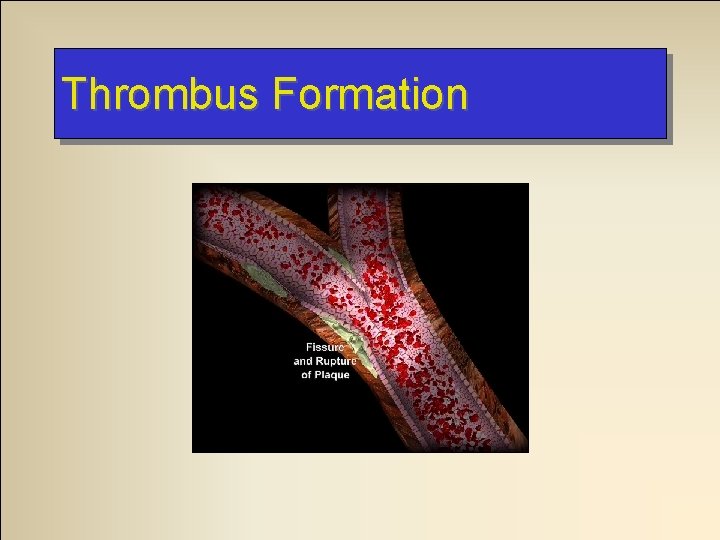 Thrombus Formation 