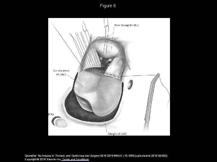 Figure 8 Operative Techniques in Thoracic and Cardiovascular Surgery 2015 2075 -86 DOI: (10.