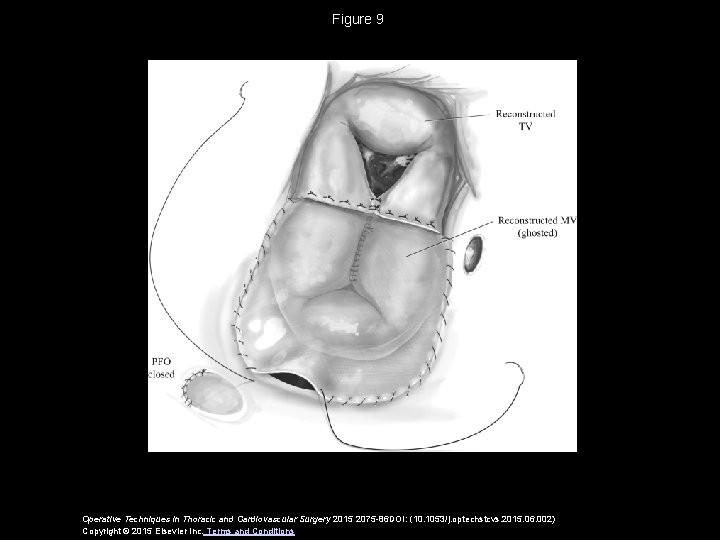 Figure 9 Operative Techniques in Thoracic and Cardiovascular Surgery 2015 2075 -86 DOI: (10.