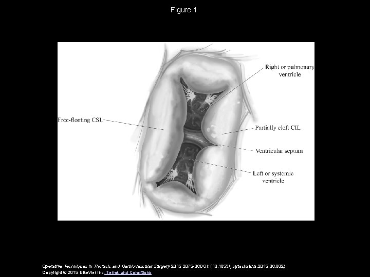 Figure 1 Operative Techniques in Thoracic and Cardiovascular Surgery 2015 2075 -86 DOI: (10.
