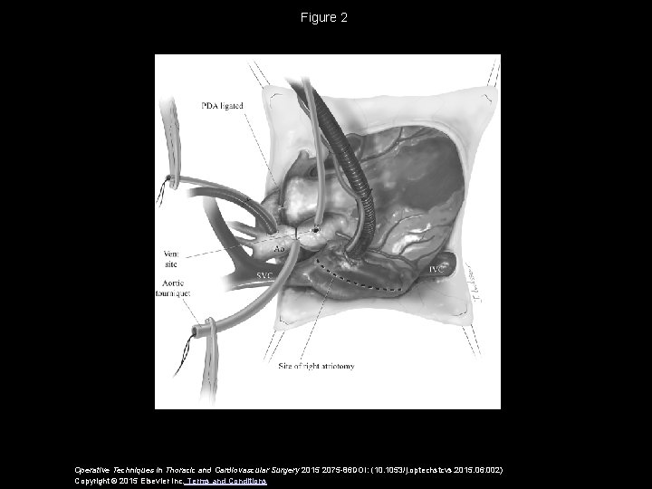 Figure 2 Operative Techniques in Thoracic and Cardiovascular Surgery 2015 2075 -86 DOI: (10.