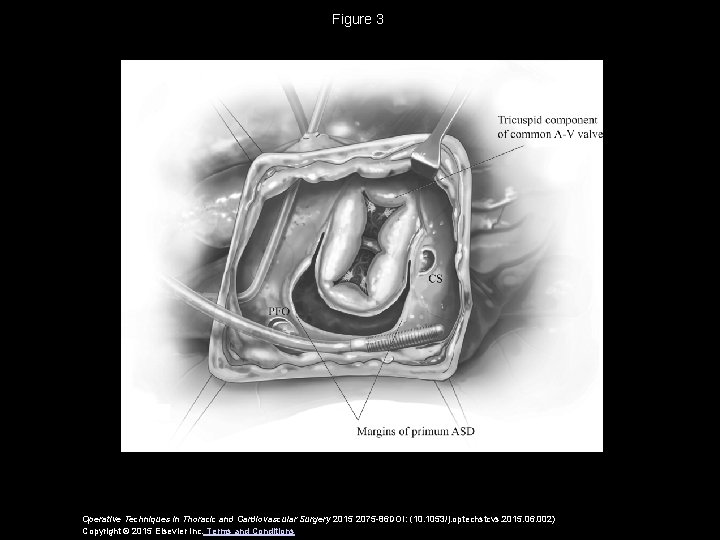 Figure 3 Operative Techniques in Thoracic and Cardiovascular Surgery 2015 2075 -86 DOI: (10.