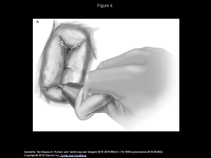 Figure 4 Operative Techniques in Thoracic and Cardiovascular Surgery 2015 2075 -86 DOI: (10.