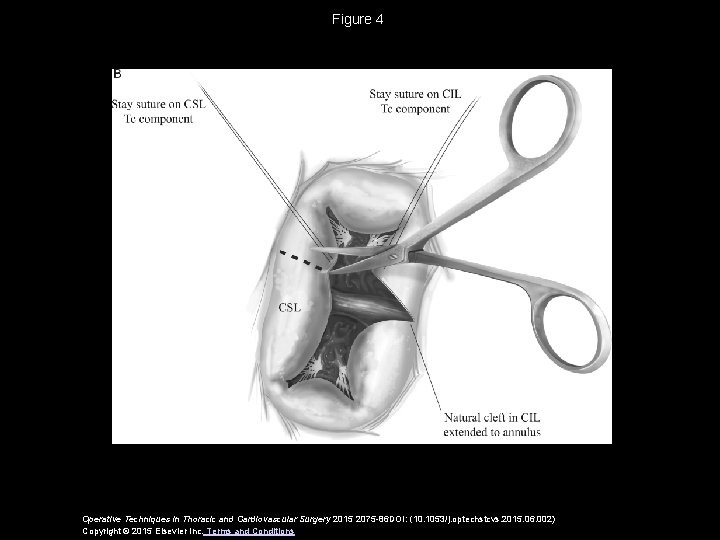 Figure 4 Operative Techniques in Thoracic and Cardiovascular Surgery 2015 2075 -86 DOI: (10.