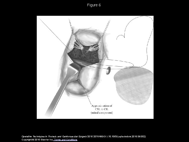 Figure 6 Operative Techniques in Thoracic and Cardiovascular Surgery 2015 2075 -86 DOI: (10.