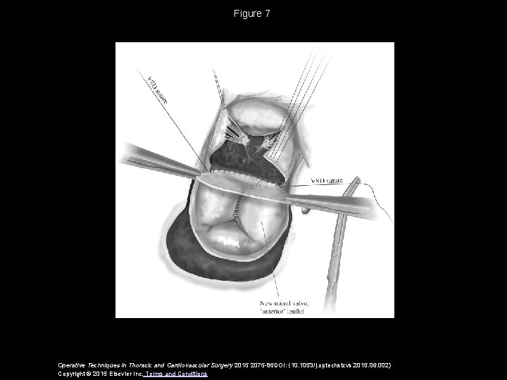 Figure 7 Operative Techniques in Thoracic and Cardiovascular Surgery 2015 2075 -86 DOI: (10.