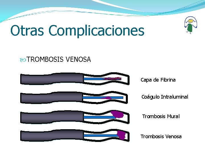 Otras Complicaciones TROMBOSIS VENOSA Capa de Fibrina Coágulo Intraluminal Trombosis Mural Trombosis Venosa 