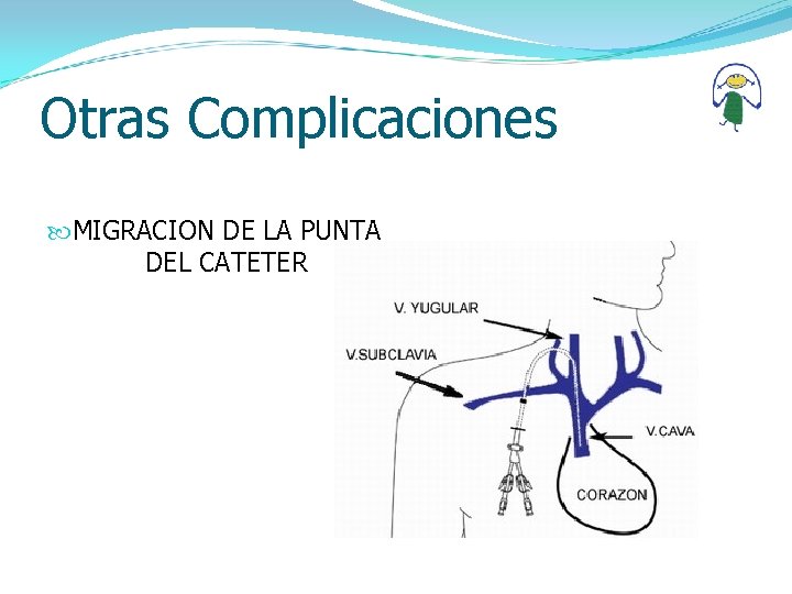 Otras Complicaciones MIGRACION DE LA PUNTA DEL CATETER 